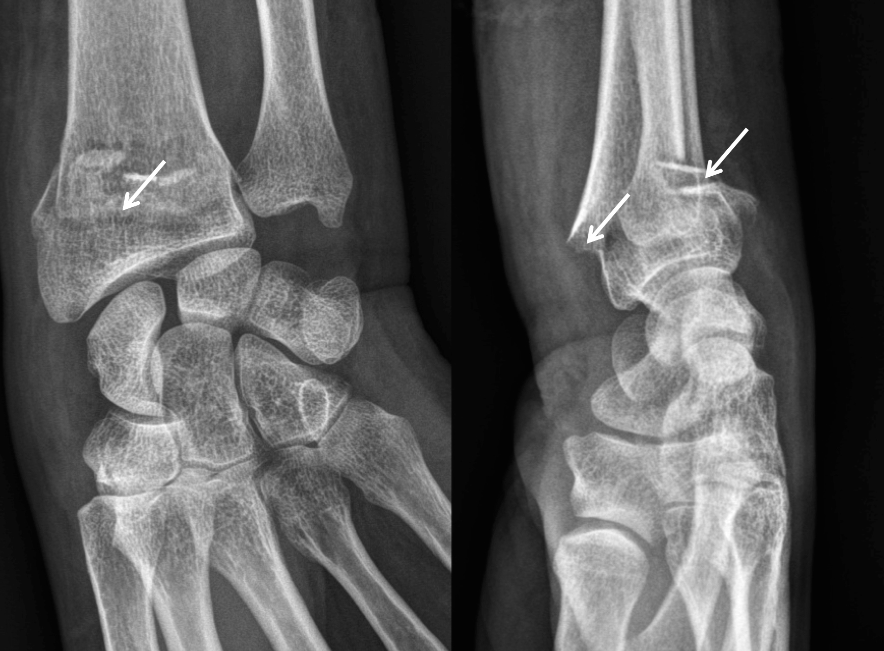 Fracture du poignet - Clinique Ostéo Articulaire des Cèdres - Grenoble