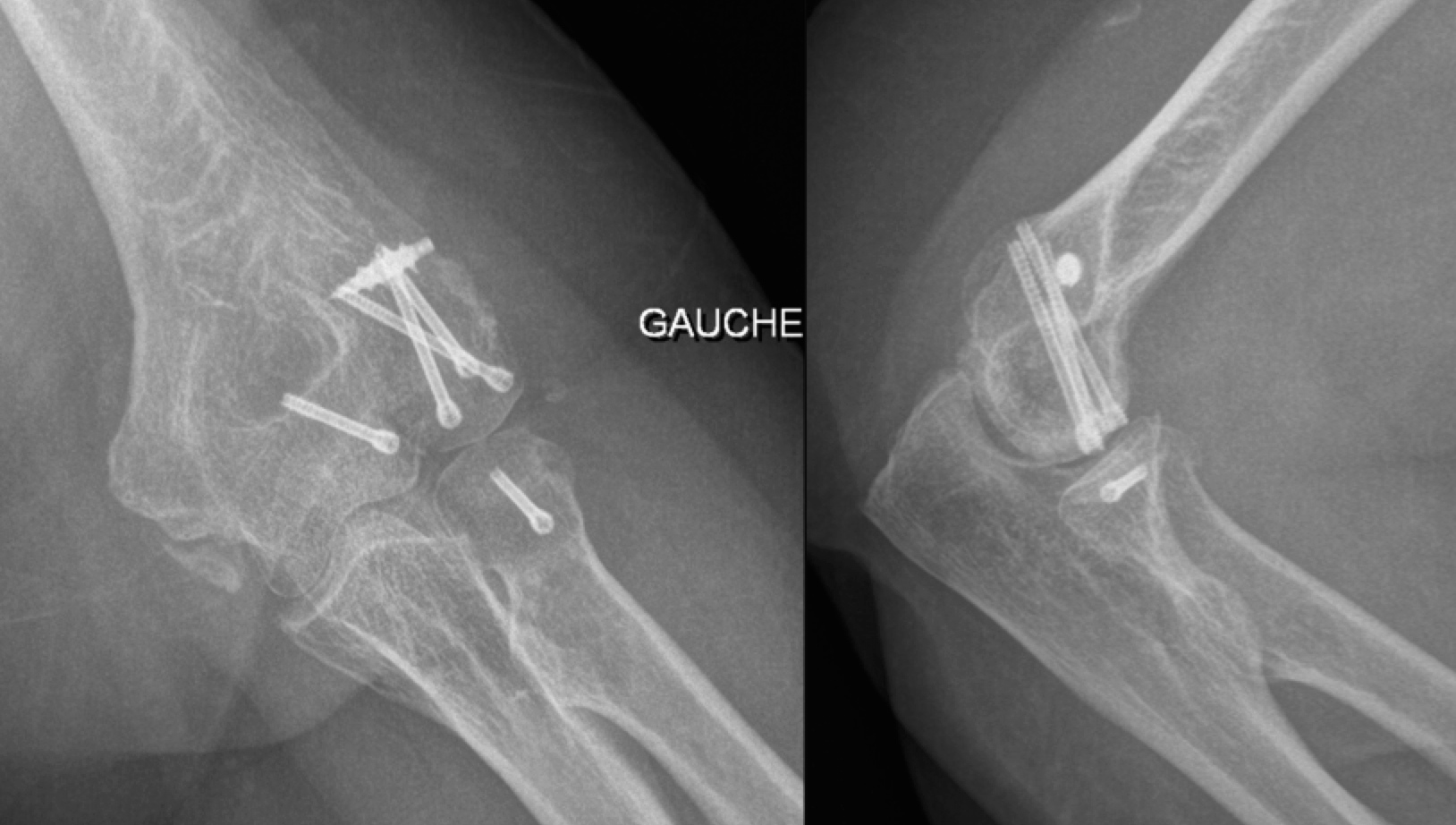 Fracture du coude - Clinique Ostéo Articulaire des Cèdres - Grenoble