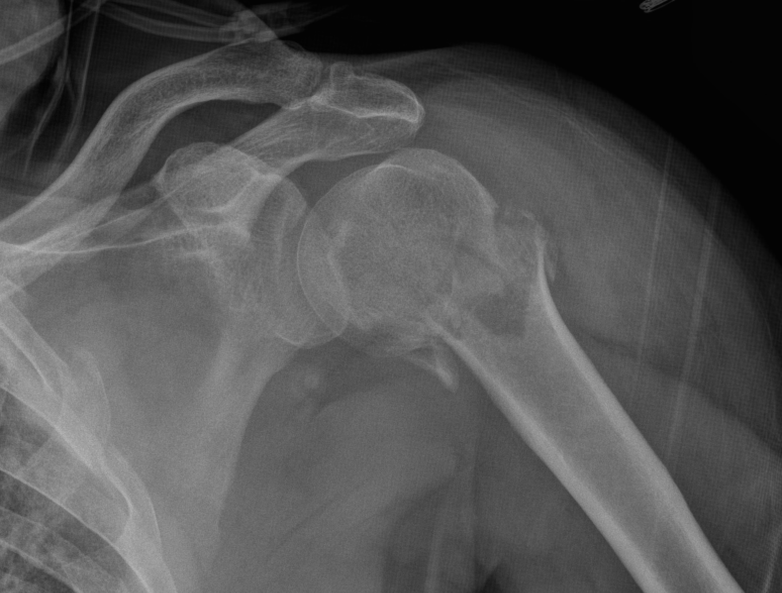 Fractures de l'épaule - Clinique Ostéo Articulaire des Cèdres ...
