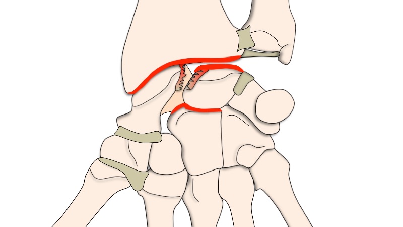 Arthrose du poignet - Clinique Ostéo Articulaire des Cèdres - Grenoble