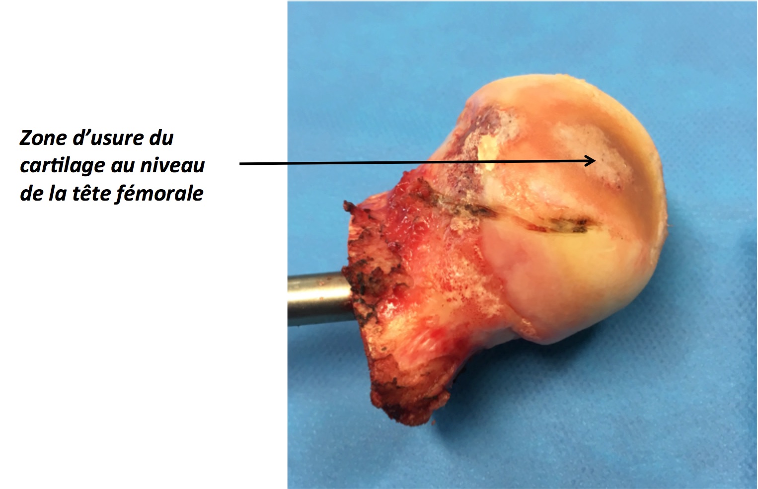 Arthrose de Hanche