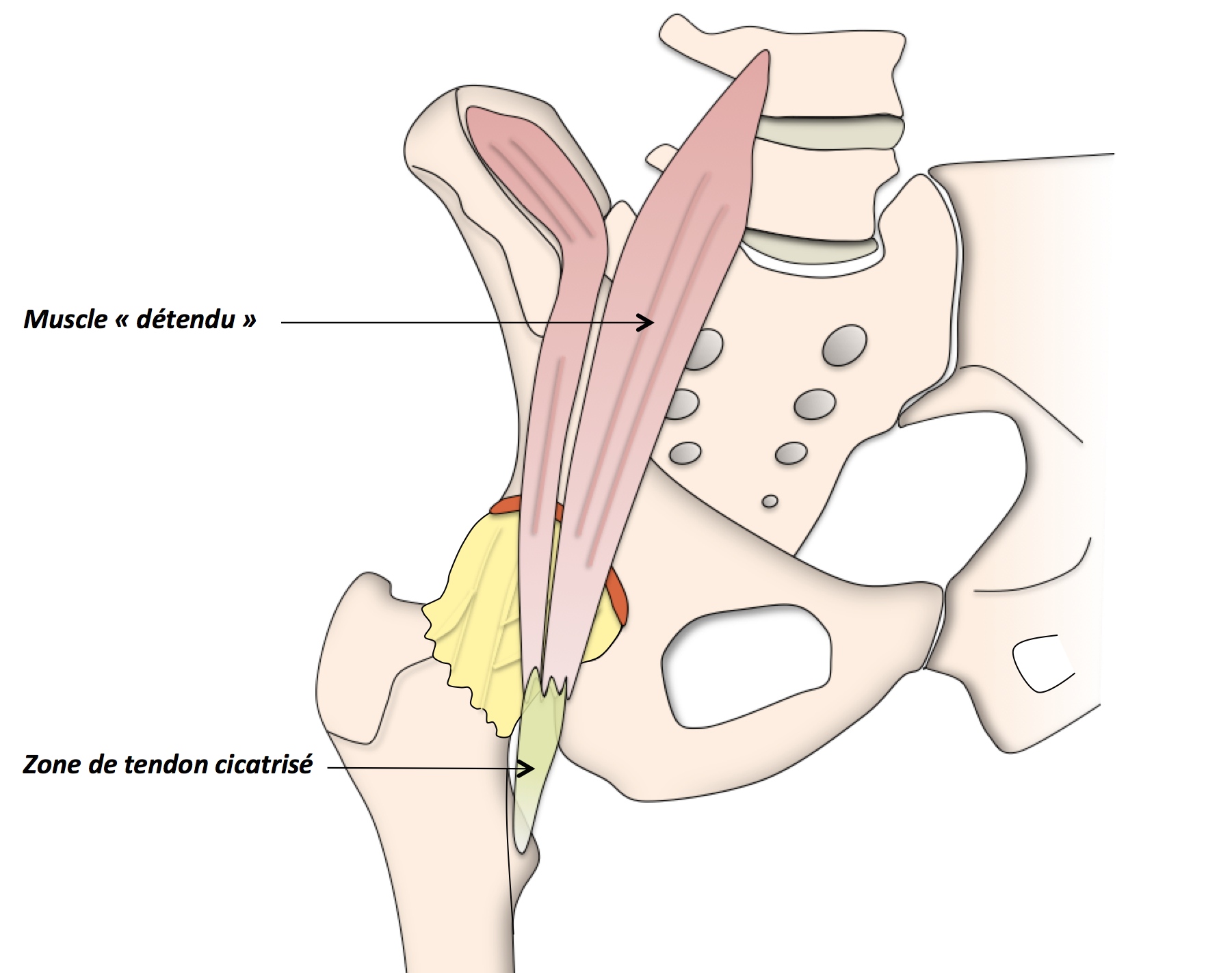 Tendinite du psoas - Clinique Ostéo Articulaire des Cèdres - Grenoble